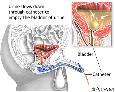 Bladder catheterization, male