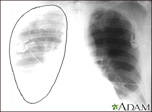Aortic rupture, chest X-ray