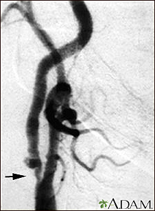 Carotid stenosis, X-ray of the right artery