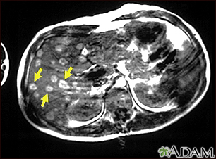 Melanoma of the liver - MRI scan