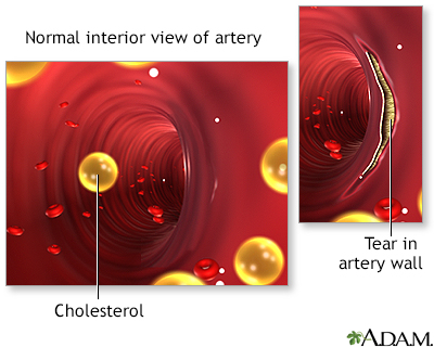 Arterial tear in internal carotid artery