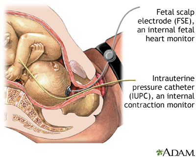 Internal Fetal Monitoring