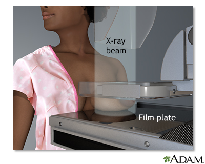 Mammography
