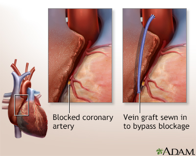 Heart bypass surgery