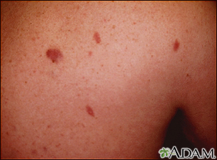 Kaposi's sarcoma - close-up