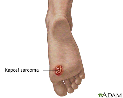 Kaposi's sarcoma on foot